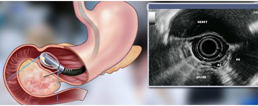 Ecoendoscopia