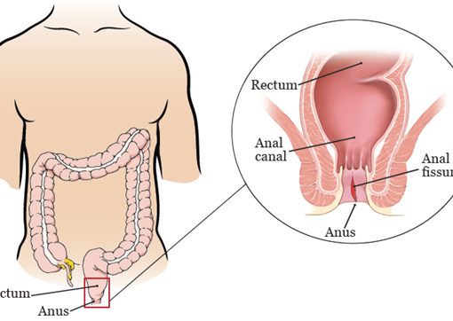 Fissura Anal