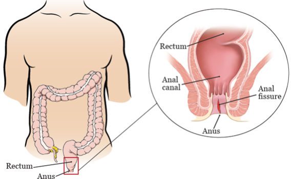 Fissura Anal