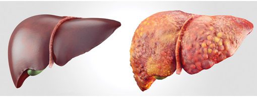 Fígado saudável e Fígado com Hepatite