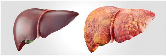 Fígado saudável e Fígado com Hepatite